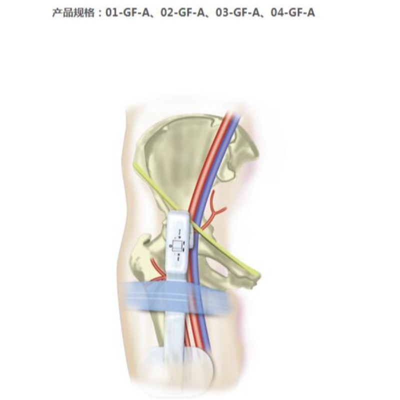 電子式大腿骨止血装置